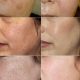 Herbalife skin booster,  all types skin problem solution